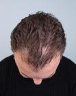 Before Hair Transplant&nbsp;Temporal Hairline